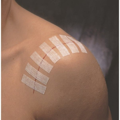 Set 3 vỉ 30 miếng dán thay chỉ khâu da 3M Steri-strip™ R1546 – Size 6mm x 100mm | Sản xuất tại Mỹ