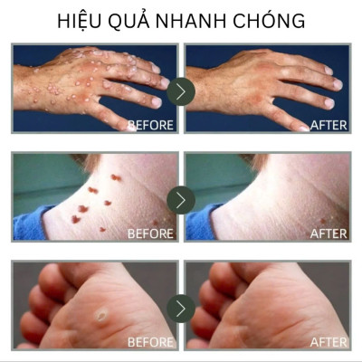 Kem Mụn Cóc, Mụn Thịt, Mụn Cơm Hiệu Quả – Chiết Xuất Thảo Dược An Toàn 20g, ĐÈN TRANG TRÍ , ĐỒNG HỒ TREO TƯỜNG