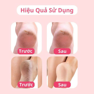 Máy Chà Gót Chân Tự Động Loại Bỏ Da Sần Chai Gây Đau, Xoá Chai Chân Hiệu Quả, ĐÈN TRANG TRÍ , ĐỒNG HỒ TREO TƯỜNG